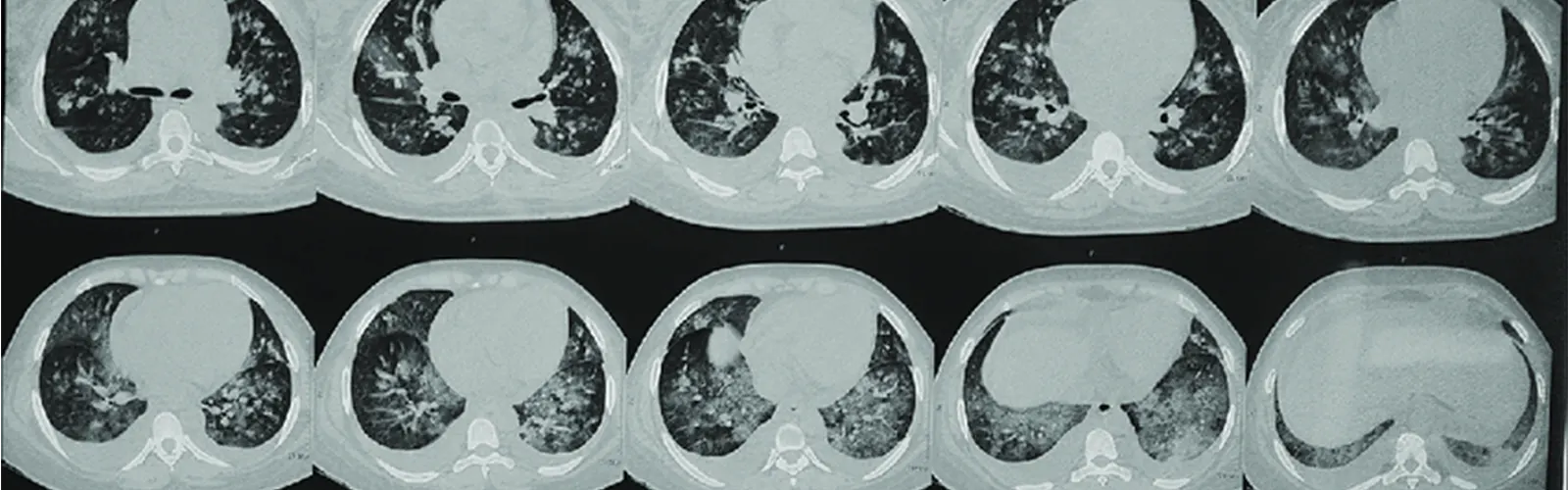 What Is the Role of NCCT Chest Scan in Follow-Up of Patients?
